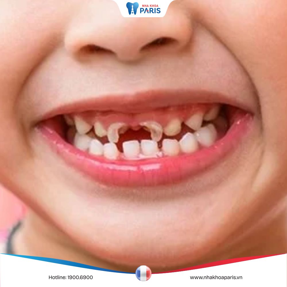 Sâu răng sữa ở trẻ nhỏ: nên nhổ bỏ hay nến trám? cách xử lý tốt nhất